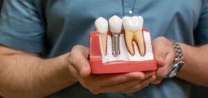 Read more about the article Dental Implants Are Effective and Hassle-Free – Addressing a Few Doubts That People Have