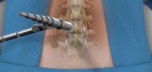 Read more about the article Minimally Invasive Spine Surgery Is Not a Woo-Woo – The Dangers of Not Opting in for One